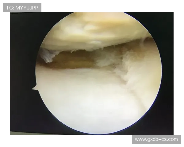 主刀医生透露迪巴拉外侧半月板完全撕裂术后恢复需45天时间 主刀医生透露迪巴拉外侧半月板完全撕裂术后恢复需45天时间